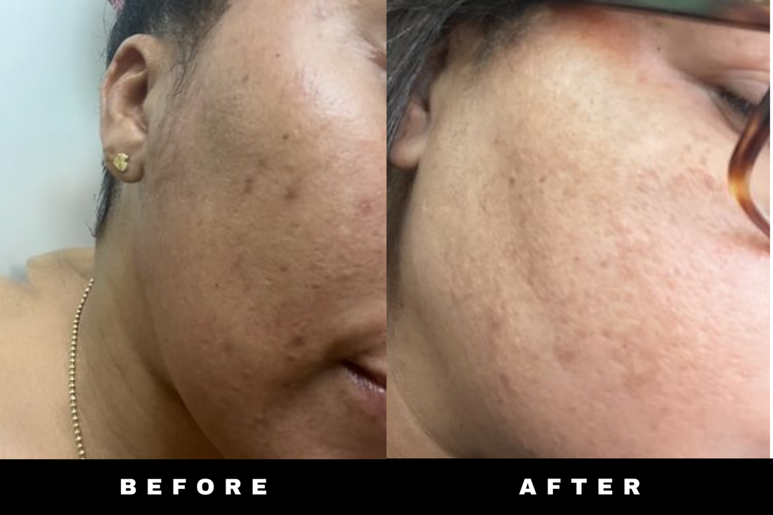 Even Tone Kit – Dark Spot &amp; Hyperpigmentation Routine