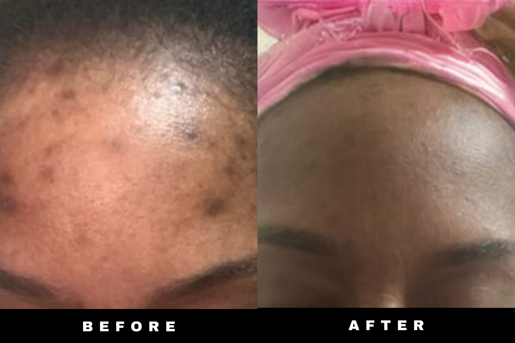 Dark Spot &amp; + Acne Away Kit